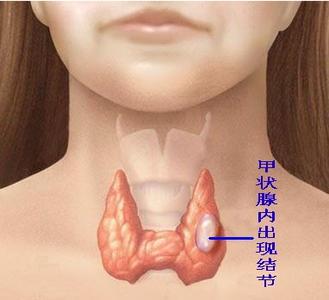 甲状腺结节