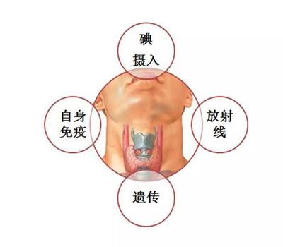 甲状腺癌