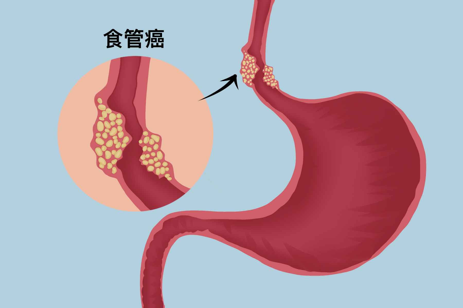 食管癌,什么是食管癌,食管癌有哪些症状 食管癌,什么是食管癌,食管癌有哪些症状